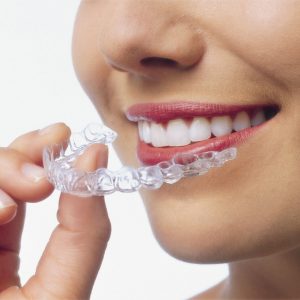 exploits valley services invisalign background image