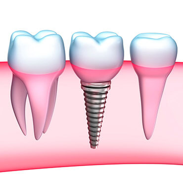 exploits valley services dental implants background image